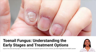 Nail Fungus: Prevention and Early Signs