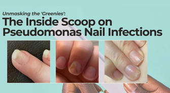 Causes of Nail Discoloration and What to Do